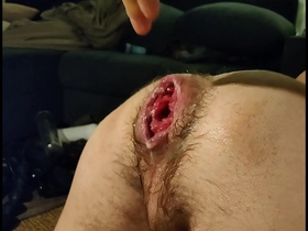 Just fisting my loose hole and Prolapse:)